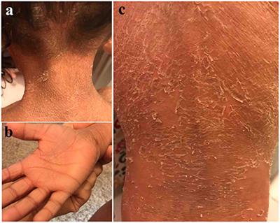 Exome Analysis Identifies a Novel Compound Heterozygous Alteration in TGM1 Gene Leading to Lamellar Ichthyosis in a Child From Saudi Arabia: Case Presentation